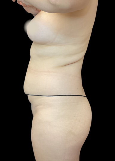 Smartlipo of the Back - Flanks, Bra Rolls, and Neck Humps