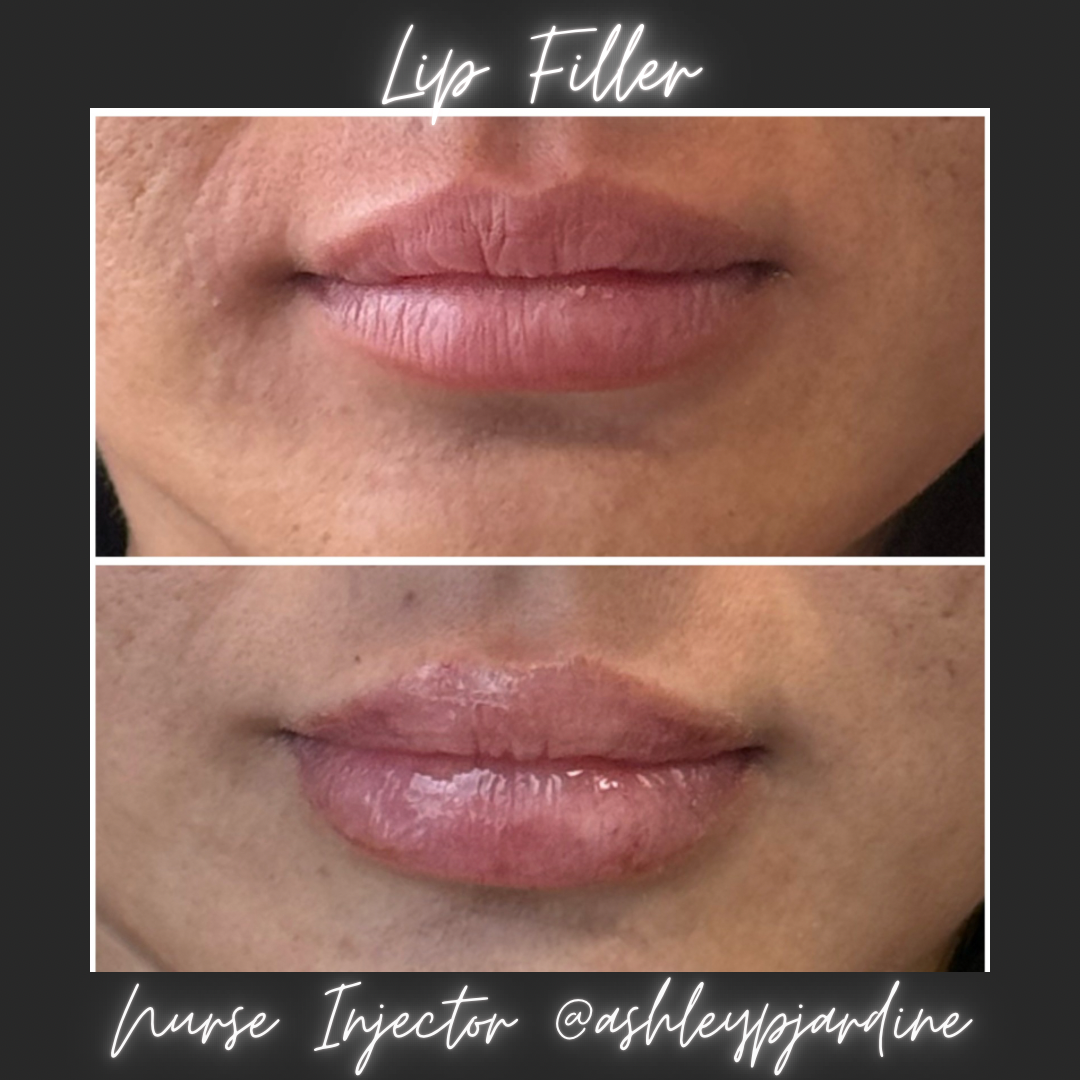 Lip filler before and after