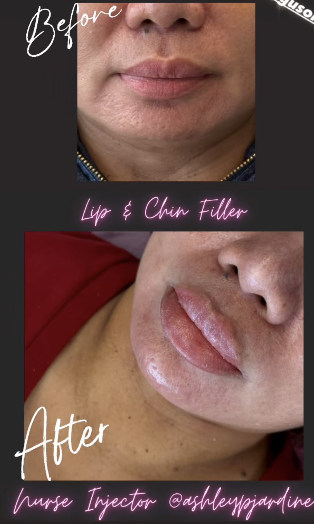 Lip filler before and after