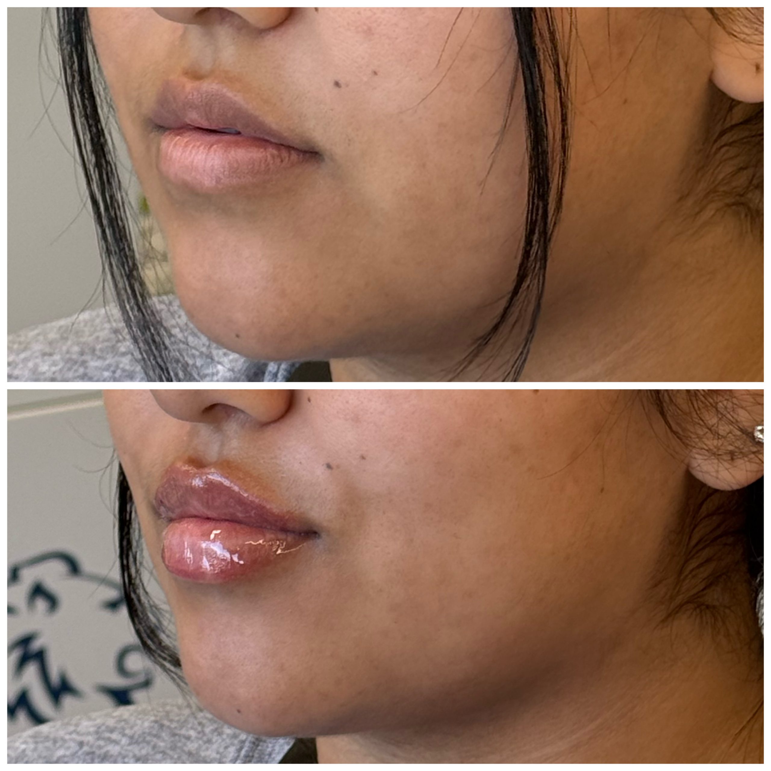 Lip filler before and after