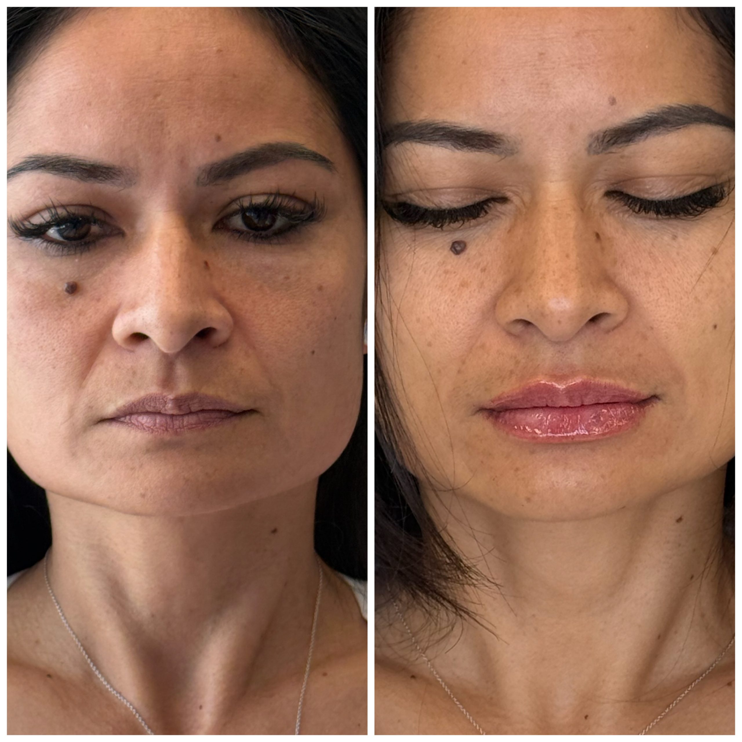 Lip filler before and after